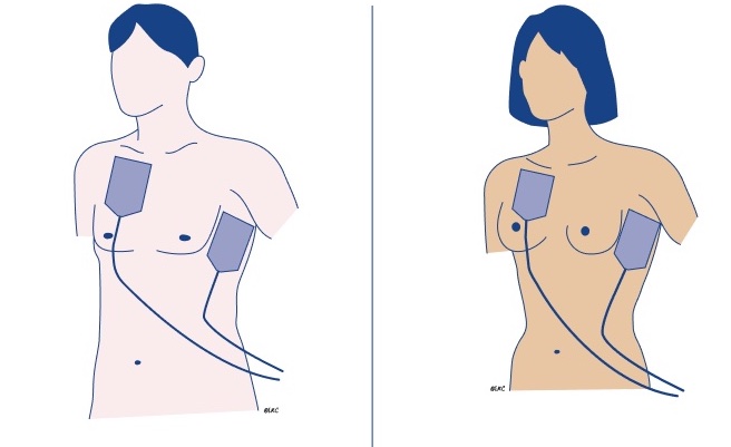 /media/firstaidtips/library/erc-pad-position.jpg